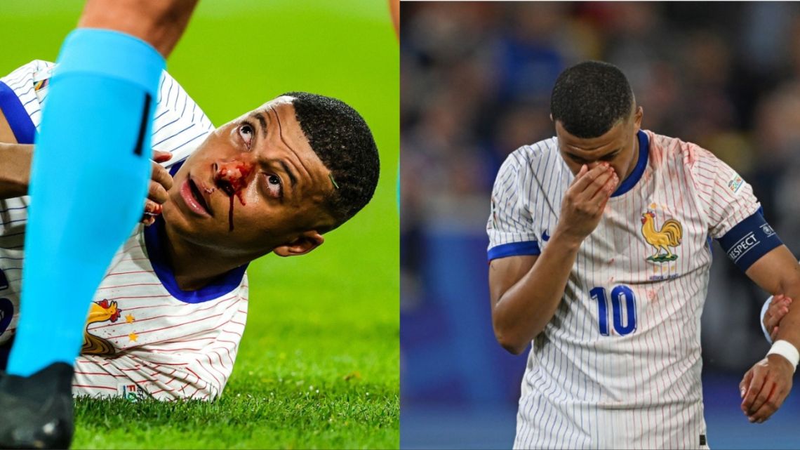 Mbappé sufrió un durísimo golpe en la nariz y podría perderse el resto de la Eurocopa