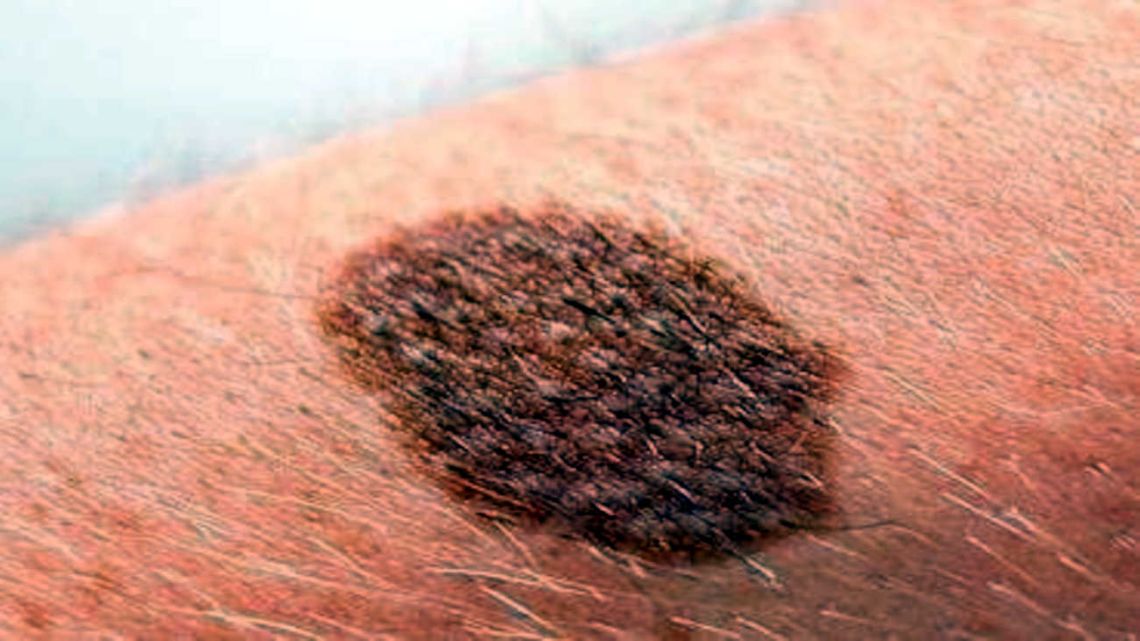 Un estudio de la OMS reveló que los rayos UV causan el 80% de los melanomas en el mundo