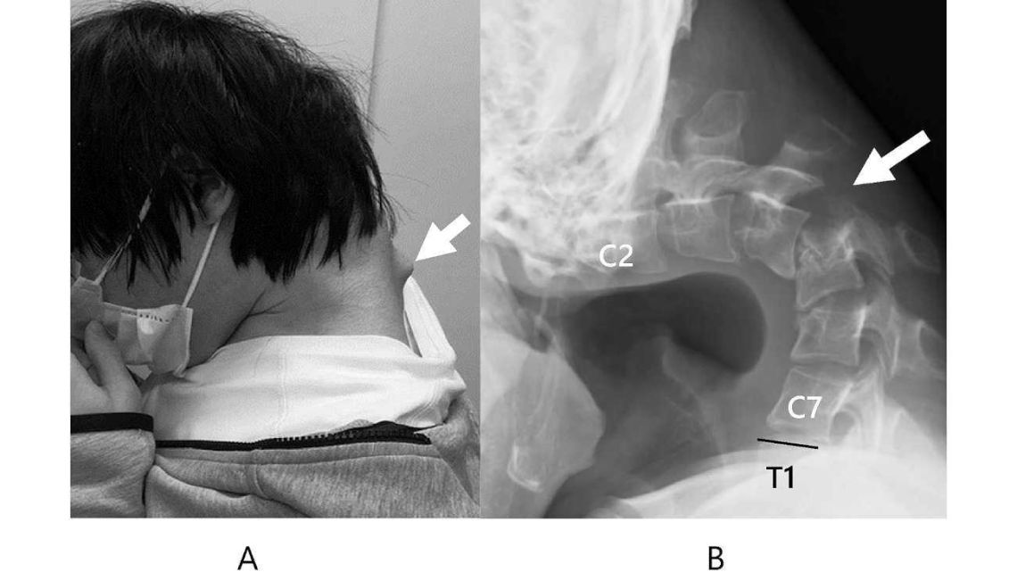 Un joven desarrolló "síndrome de la cabeza caída" por usar mucho el celular: sufrió una deformación "extrema" en el cuello